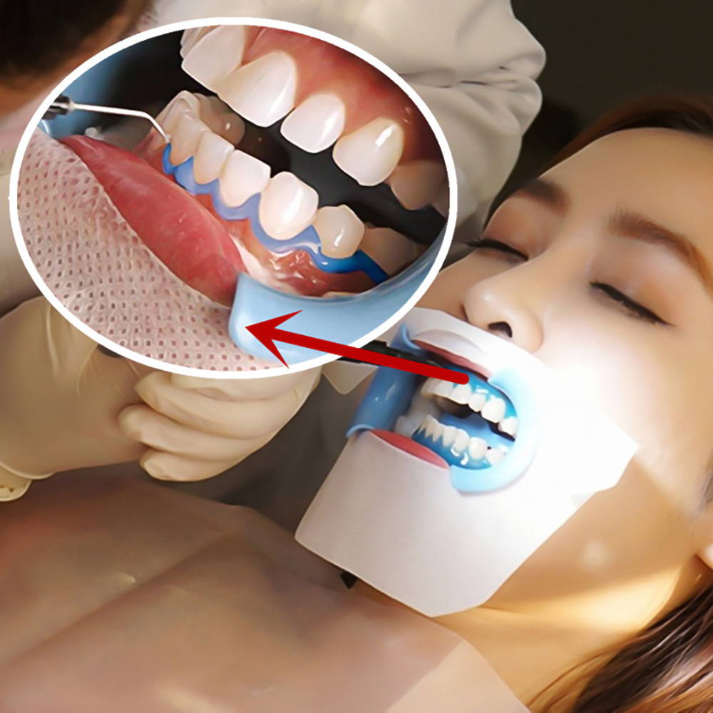 VIP -professional teeth whitening kit-2kits with 40pcs gum protection barriers