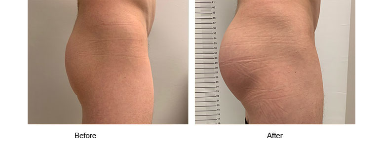Buttock Enhancement Before and After Photos - SF Plastic Surgeon