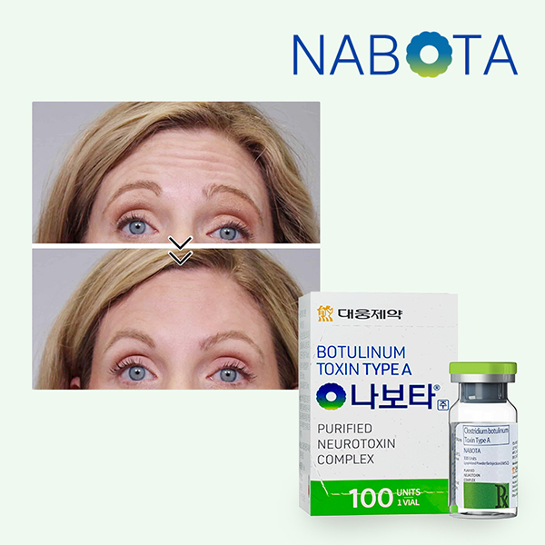 Nabota 100 Units Korean Brand Botox-iRENICE