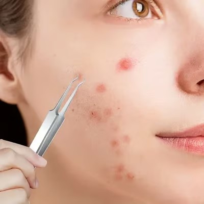 🔥Professional Facial Blackhead Remover Tweezers(50% OFF!!!)