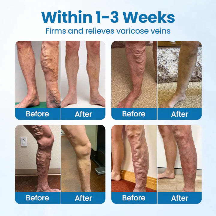Timilk® VeinGuard Herbal Spray-✅ Clinically proven to eliminate varicose veins in just 7 days!