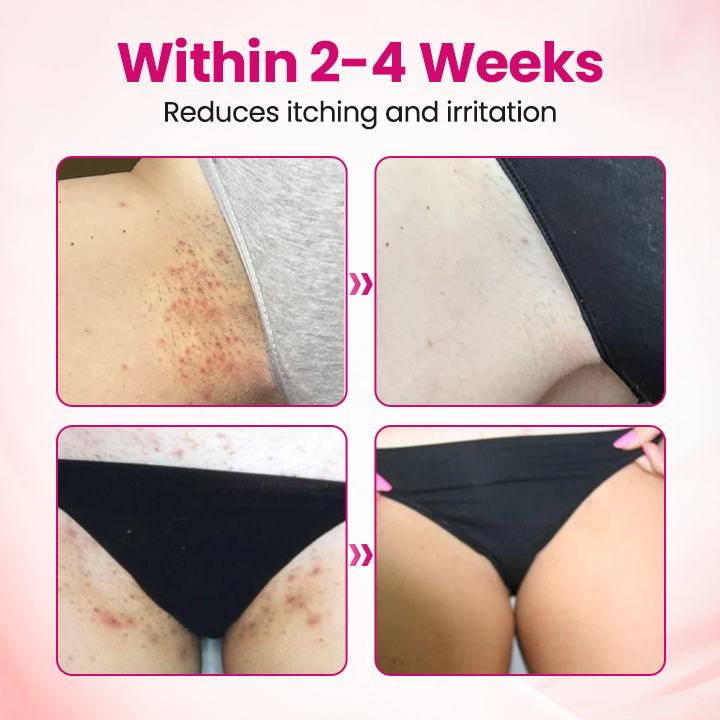 AnnieCare® IntiDefend Anti-HPV Interferon Gel