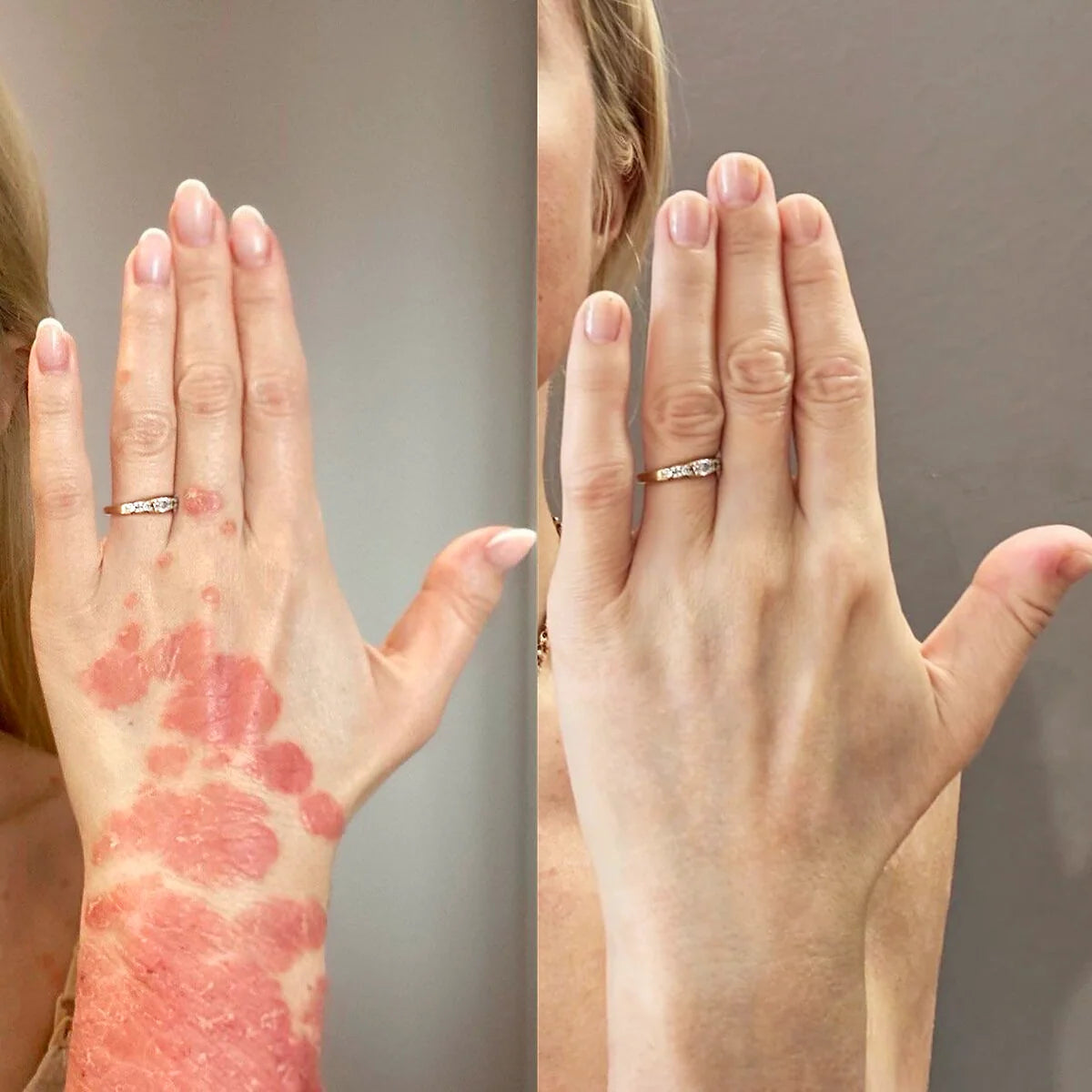 Reference-page before and after appearance example showing red scaly patches on the hand