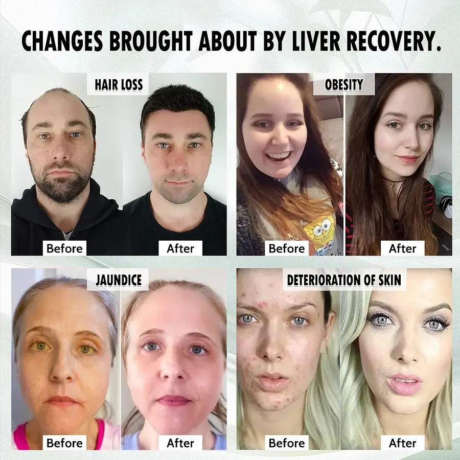 AnnieCare® Natural Herbal Liver Supplement