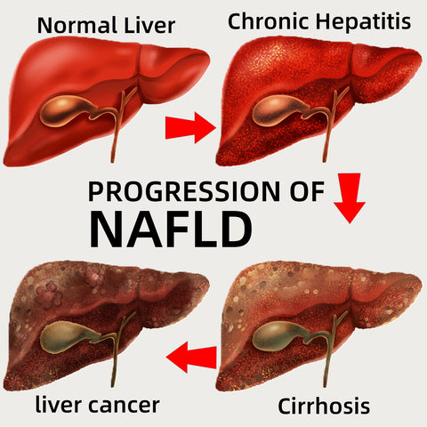 AnnieCare® Natural Herbal Liver Supplement