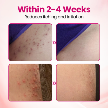 AnnieCare® IntiDefend Anti-HPV Interferon Gel