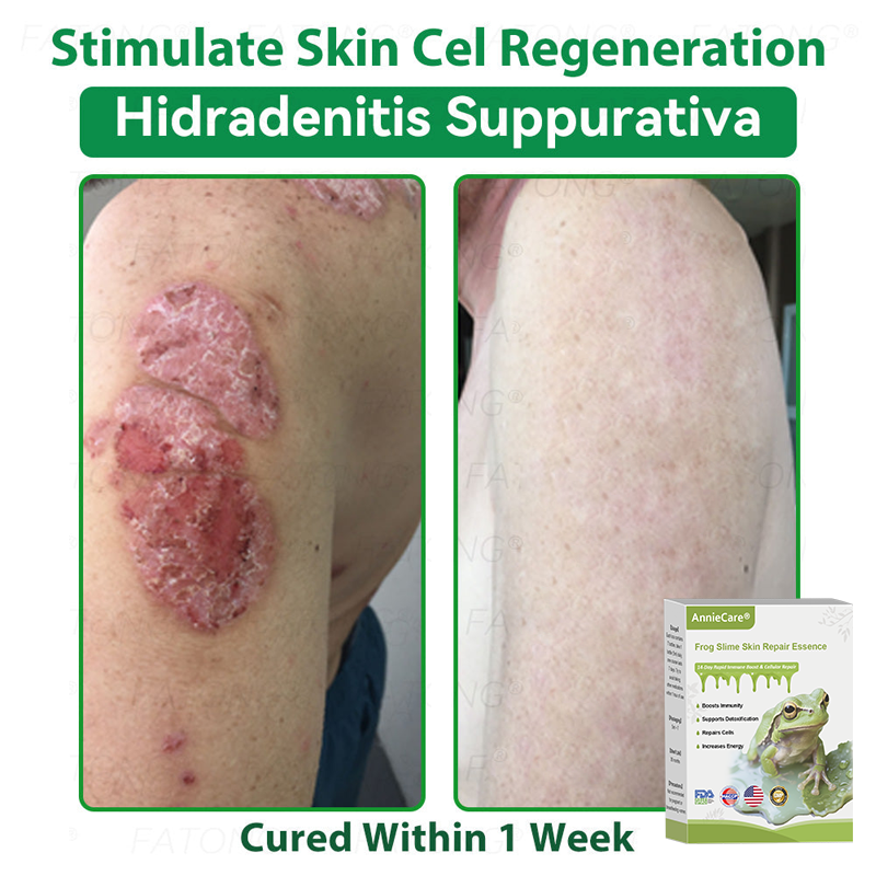 Anniecare® Frog Slime Skin Repair Essence🐸