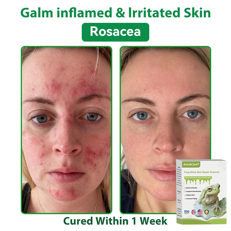 Anniecare® Frog Slime Skin Repair Essence🐸