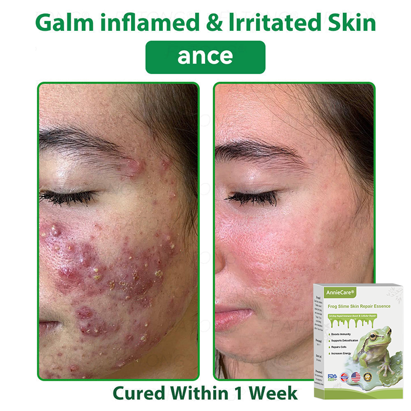 Anniecare® Frog Slime Skin Repair Essence🐸