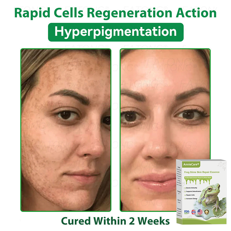 Anniecare® Frog Slime Skin Repair Essence🐸