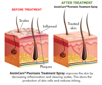AnnieCare® Psoriasis Treatment Spray