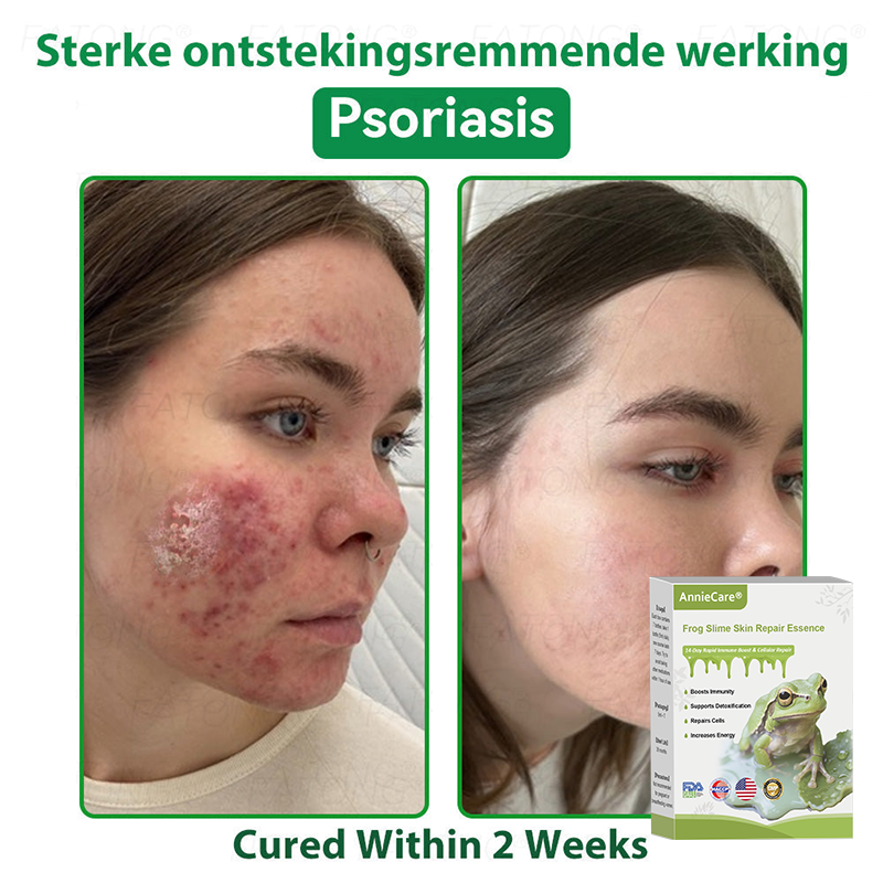 Anniecare® Frog Slime Skin Repair Essence🐸