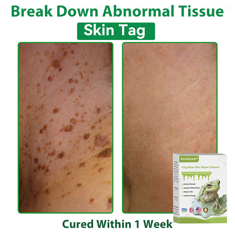 Anniecare® Frog Slime Skin Repair Essence🐸