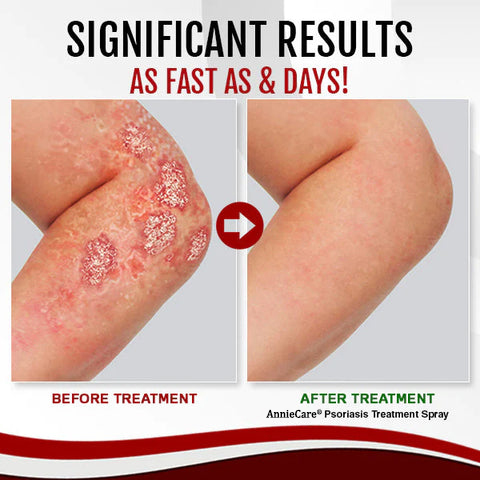 AnnieCare® Psoriasis Treatment Spray