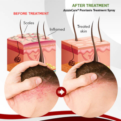 AnnieCare® Psoriasis Treatment Spray
