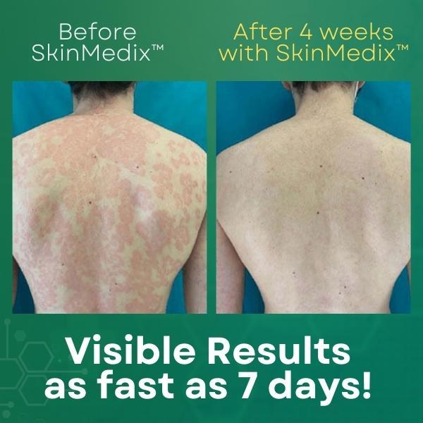 𝐒𝐤𝐢𝐧𝐌𝐞𝐝𝐢𝐱 𝐍𝐚𝐭𝐮𝐫𝐚𝐥 𝐇𝐞𝐫𝐛𝐚𝐜𝐞𝐨𝐮𝐬 𝐏𝐥𝐚𝐧𝐭𝐬 𝐏𝐬𝐨𝐫𝐢𝐚𝐬𝐢𝐬 𝐂𝐫𝐞𝐚𝐦