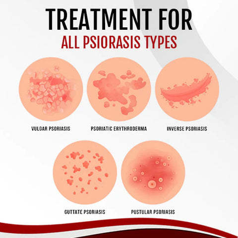 AnnieCare® Psoriasis Treatment Spray