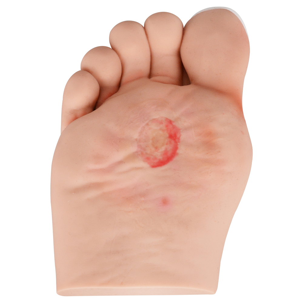 diabetic foot ulcer stage 1