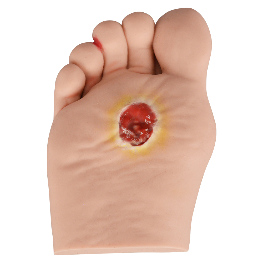 diabetic foot ulcer stage 2