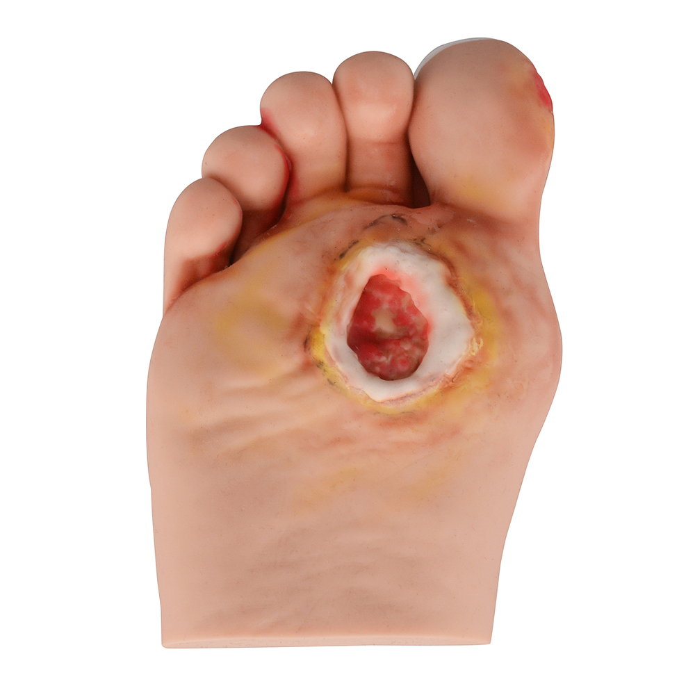 diabetic foot ulcer stage 3