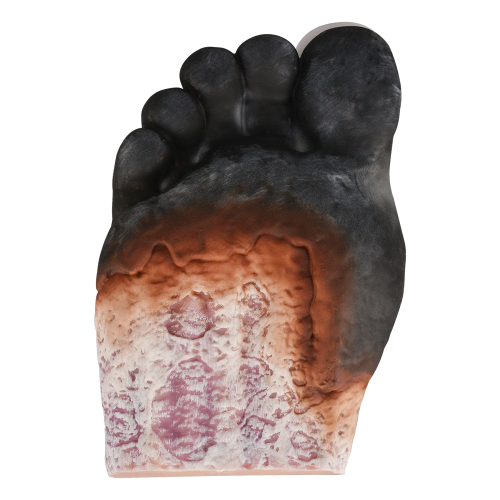 diabetic foot ulcer stage 5