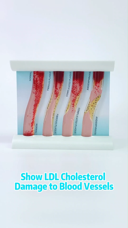 4-Vessel Blood Vessel Blockage Model - Hyperlipidemia Simulation Tool