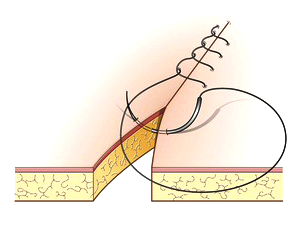 suture continue simple 