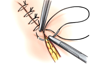 suture simple interrompue 