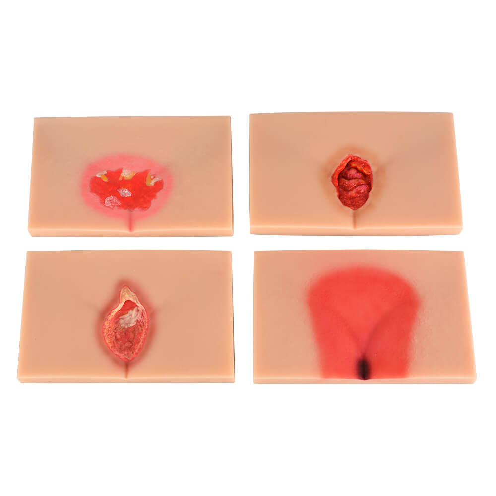 4-Stage Decubitus Pressure Ulcer Wound Care Training Model Kit