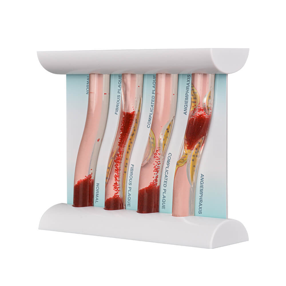 4-Vessel Blood Vessel Blockage Model – Hyperlipidemia Simulation Tool