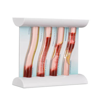4-Vessel Blood Vessel Blockage Model – Hyperlipidemia Simulation Tool