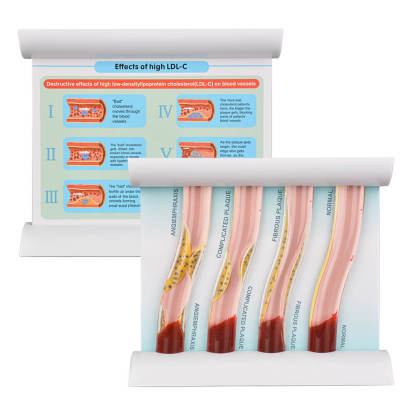 4-Vessel Blood Vessel Blockage Model – Hyperlipidemia Simulation Tool