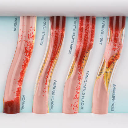 4-Vessel Blood Vessel Blockage Model – Hyperlipidemia Simulation Tool