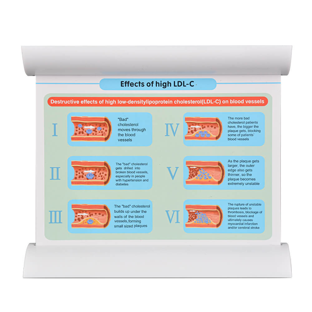 4-Vessel Blood Vessel Blockage Model – Hyperlipidemia Simulation Tool