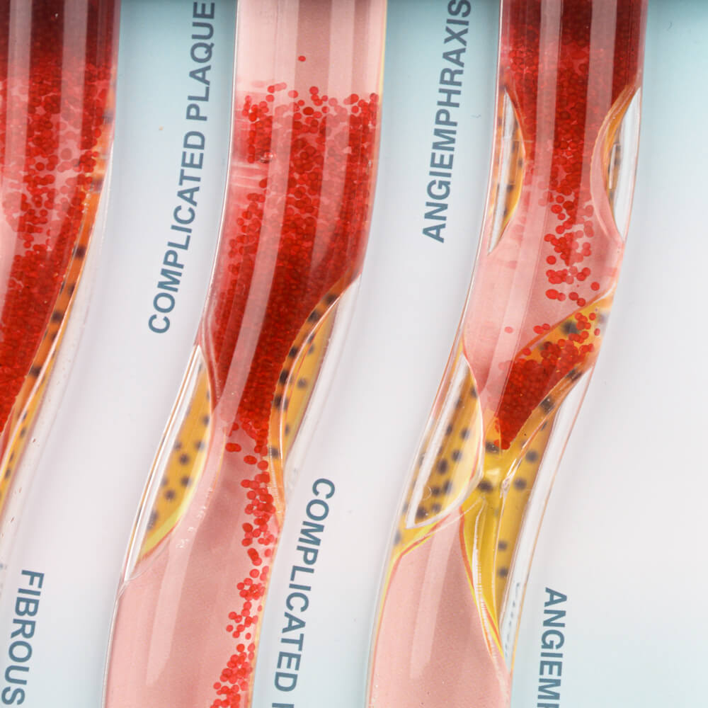 4-Vessel Blood Vessel Blockage Model – Hyperlipidemia Simulation Tool