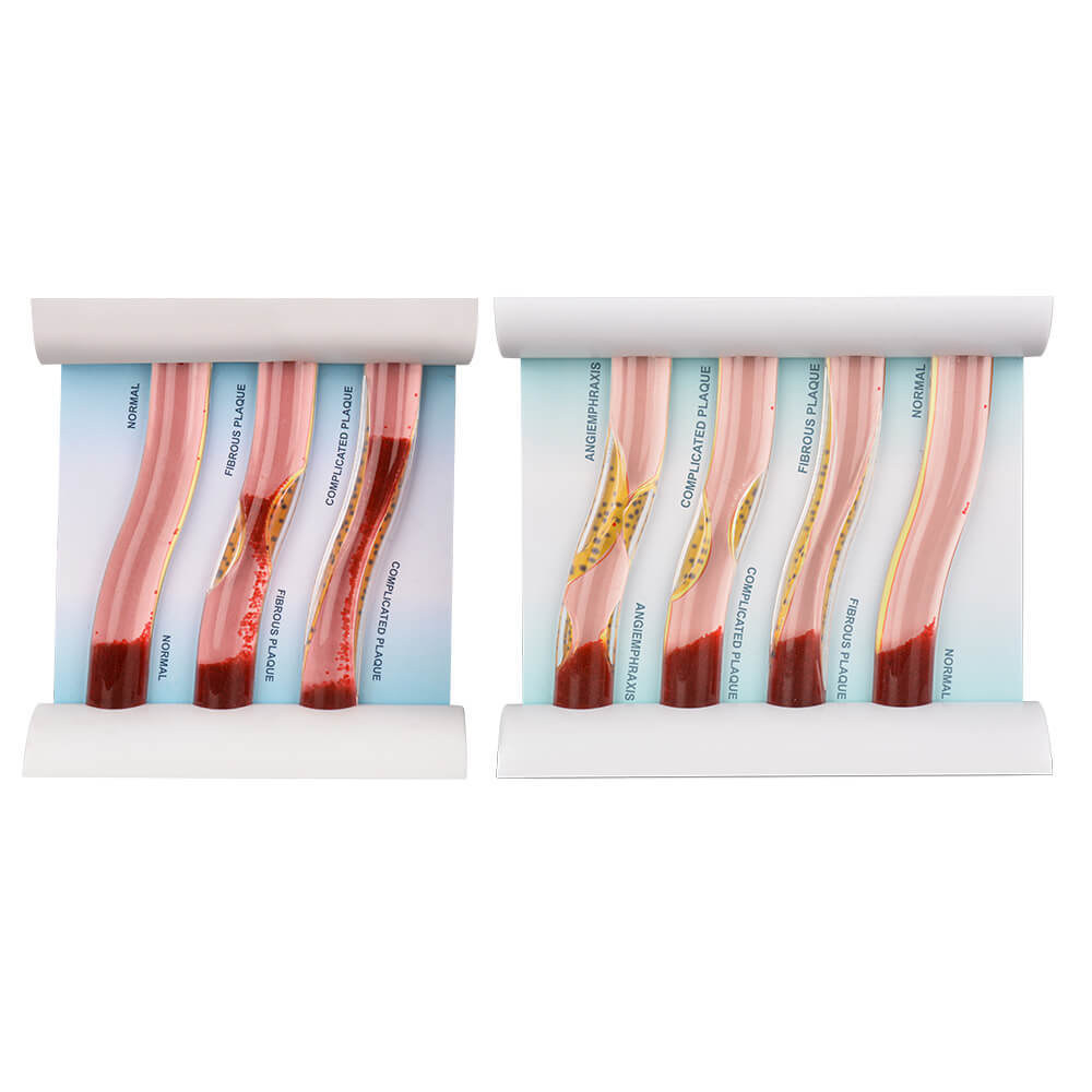 4-Vessel Blood Vessel Blockage Model – Hyperlipidemia Simulation Tool