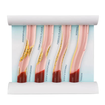 4-Vessel Blood Vessel Blockage Model – Hyperlipidemia Simulation Tool