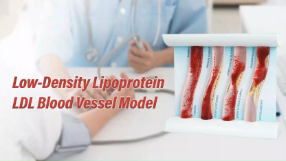 4-Vessel Blood Vessel Blockage Model - Hyperlipidemia Simulation Tool