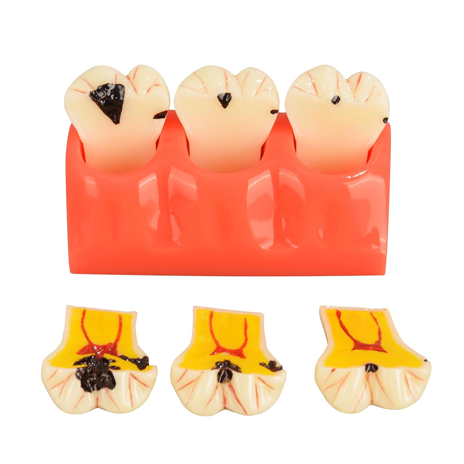 4X Dental Caries Tooth Model for Oral Health Education