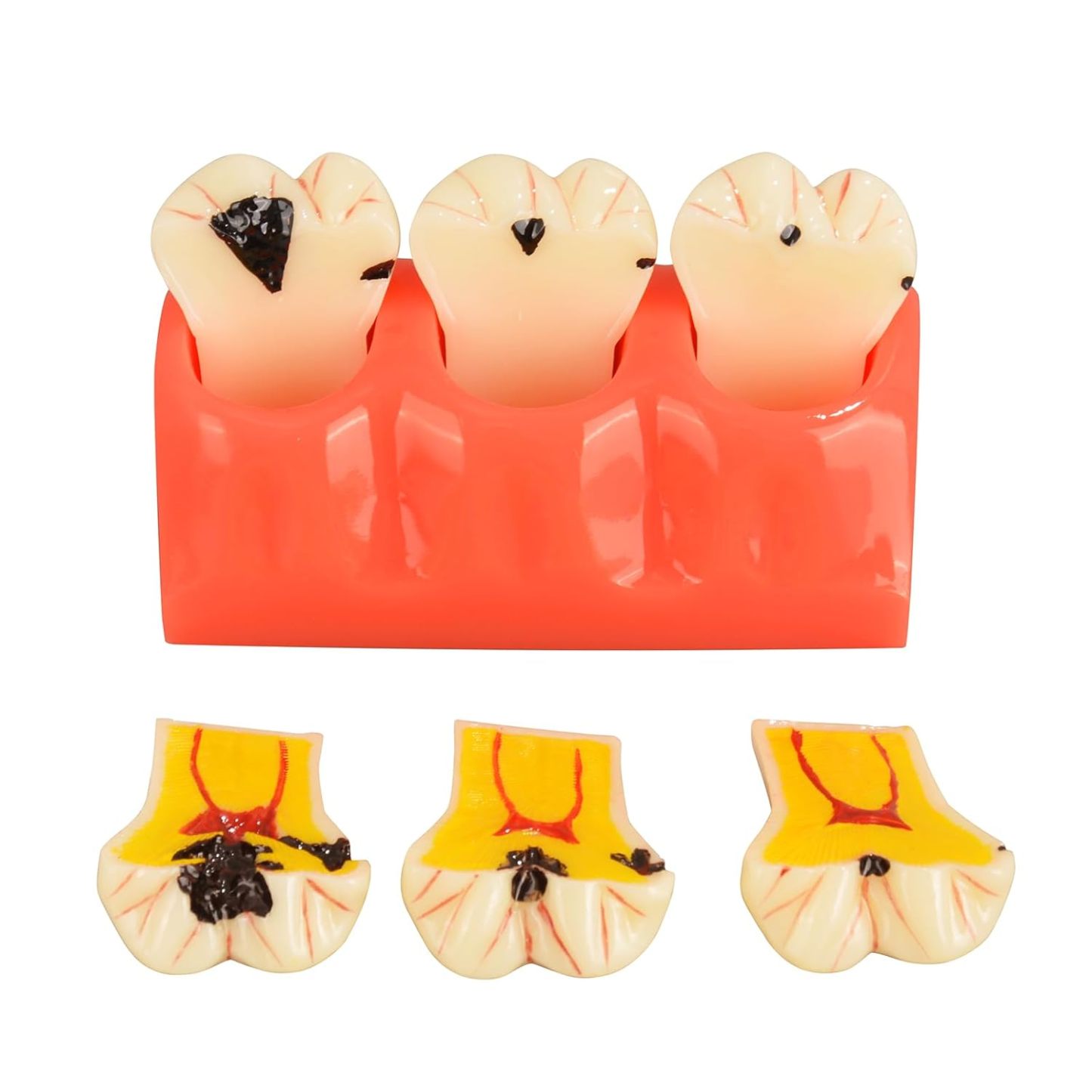 4X Dental Caries Tooth Model for Oral Health Education