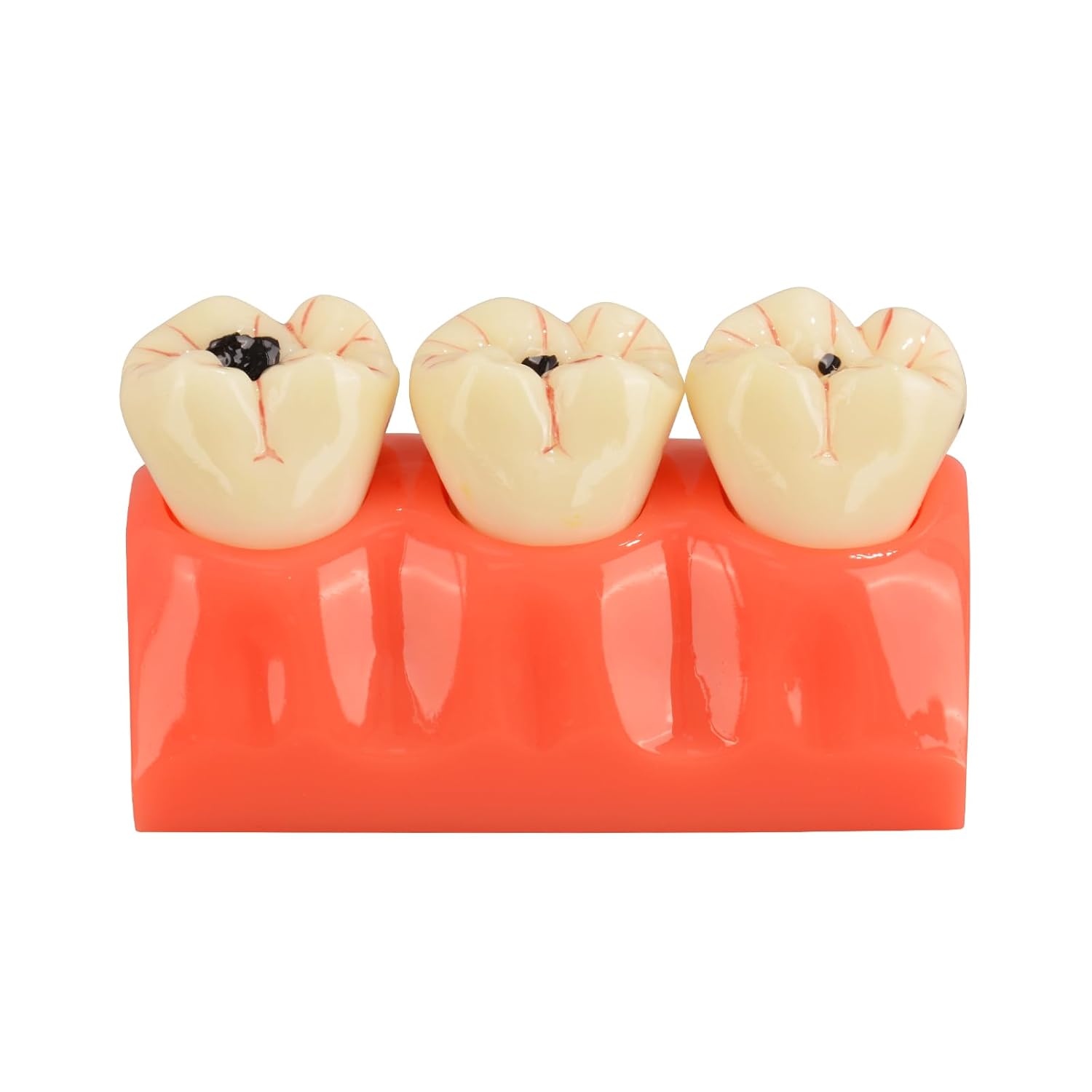 4X Dental Caries Tooth Model for Oral Health Education