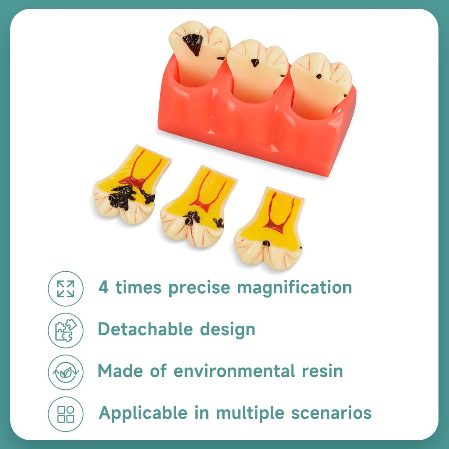 4X Dental Caries Tooth Model for Oral Health Education