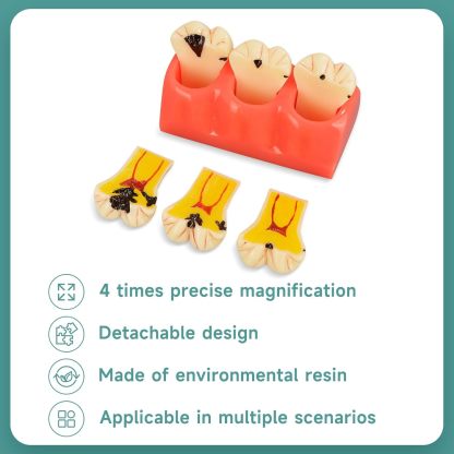 4X Dental Caries Tooth Model for Oral Health Education