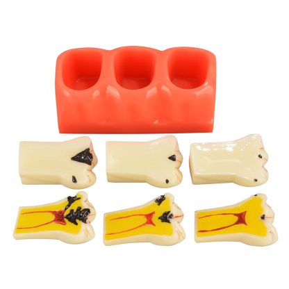 4X Dental Caries Tooth Model for Oral Health Education