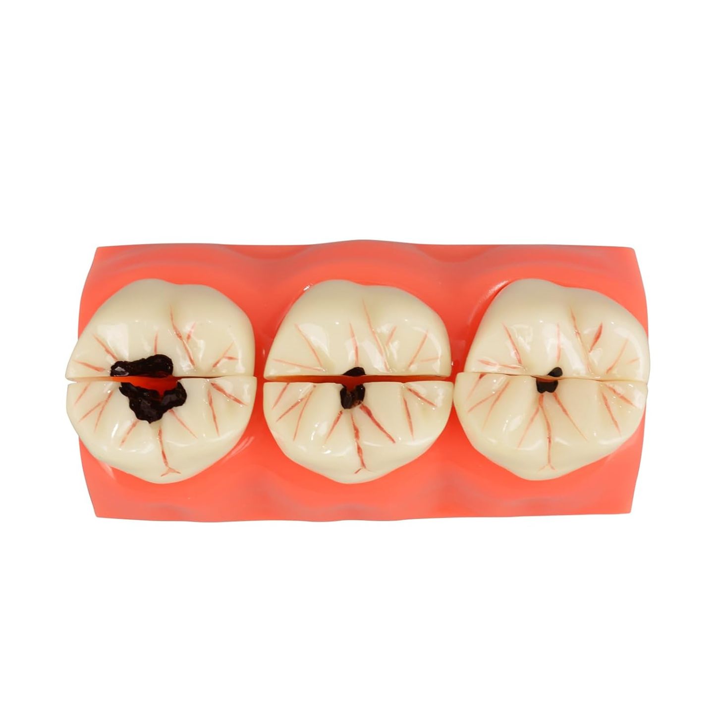 4X Dental Caries Tooth Model for Oral Health Education