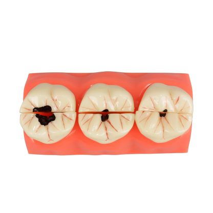 4X Dental Caries Tooth Model for Oral Health Education
