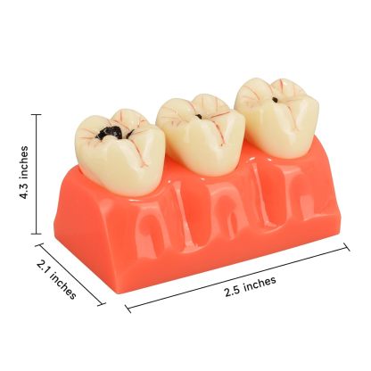 4X Dental Caries Tooth Model for Oral Health Education