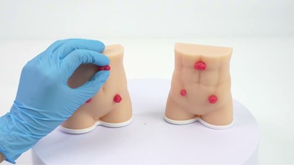 Handheld Stoma Demonstration Models (Set of 2)