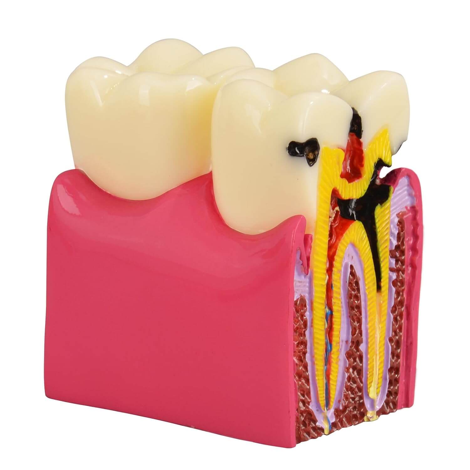 6X Dental Caries Comparison Tooth Decay Model for Teaching