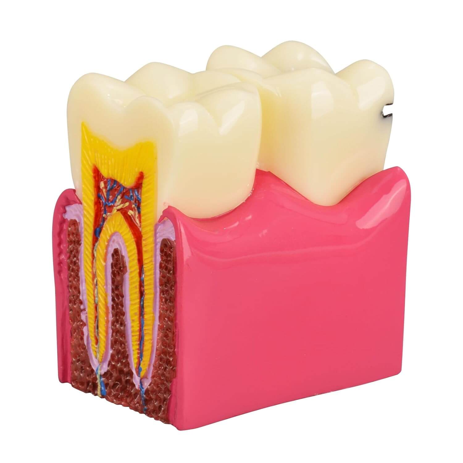 6X Dental Caries Comparison Tooth Decay Model for Teaching